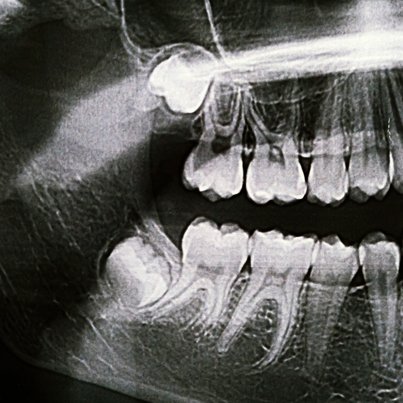 Common Problems Caused by Impacted Wisdom Teeth
