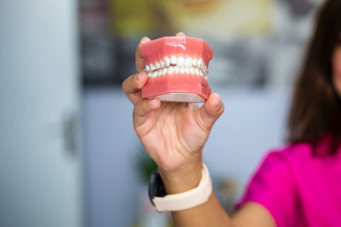 Benefits of Implant-Supported Dentures